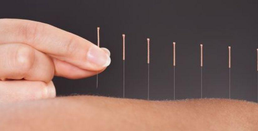 Medicinska akupunktura